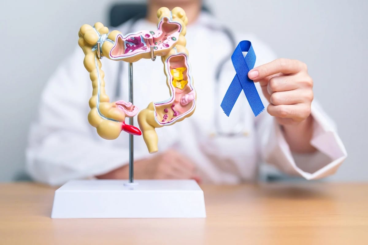 Colon Cancer